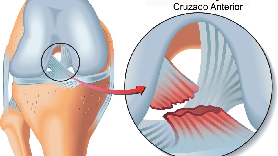 Dr. Emmanuel Díaz de León – Lesiones de Ligamentos en Rodillas – 29 de Diciembre 2015 #Salud