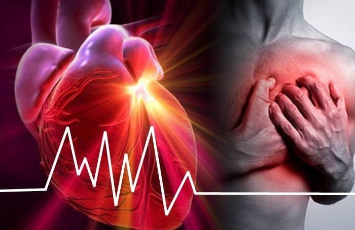 Infarto al miocardio: todo lo que debes saber