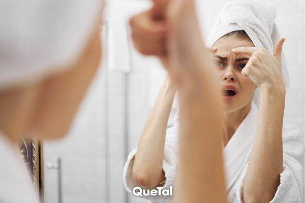 ¿Sufres de acné? El estrés podría ser la causa