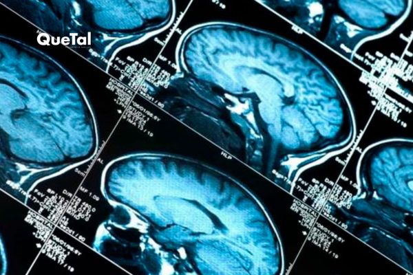 Descubren 13 proteínas relacionadas con el envejecimiento cerebral