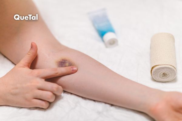 ¿Por qué aparecen moretones con facilidad? Lo que debes saber